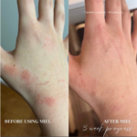 one hand with psoriasis and  after treatment with healing balm. 